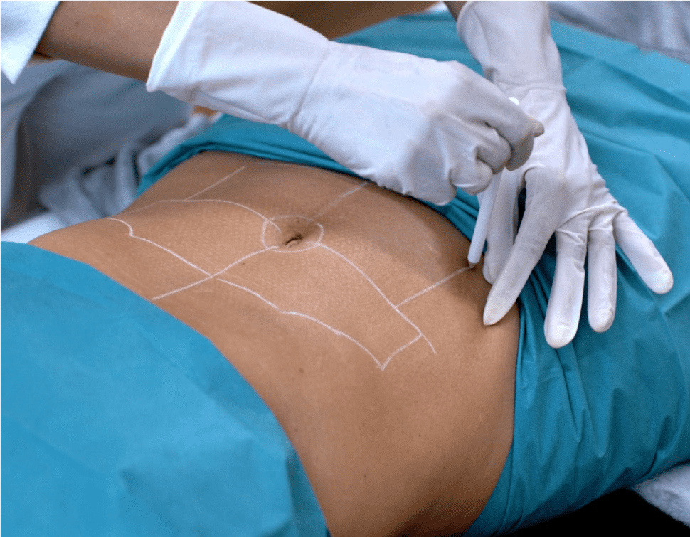 Průběh ošetření břicha metodou Endolift na klientce 45 let na klinice Formositas Praha