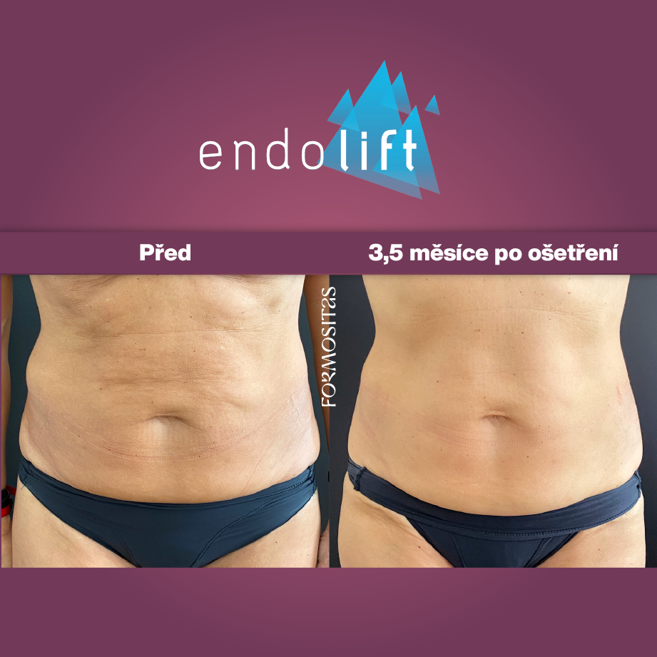 Před a po: výsledek ošetření břicha metodou Endolift na klinice Formositas Praha